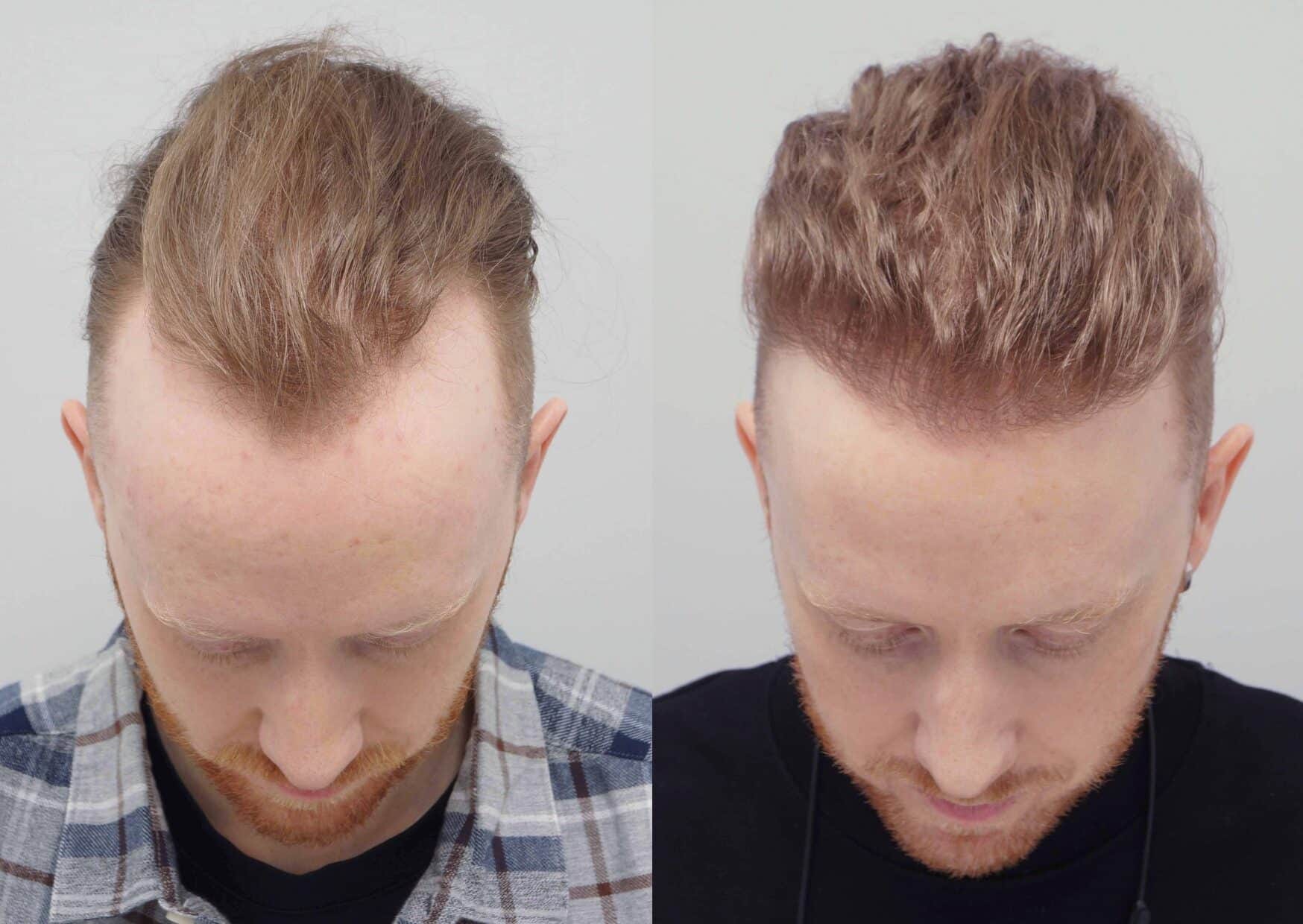 Hair Transplant – How Westminster Medical Group® Restores Confidence