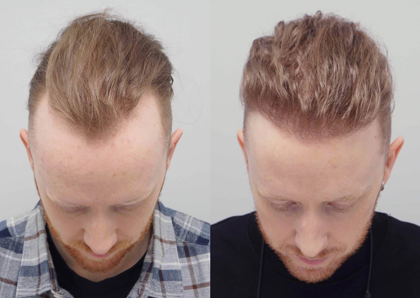Hair Transplant – How Westminster Medical Group® Restores Confidence