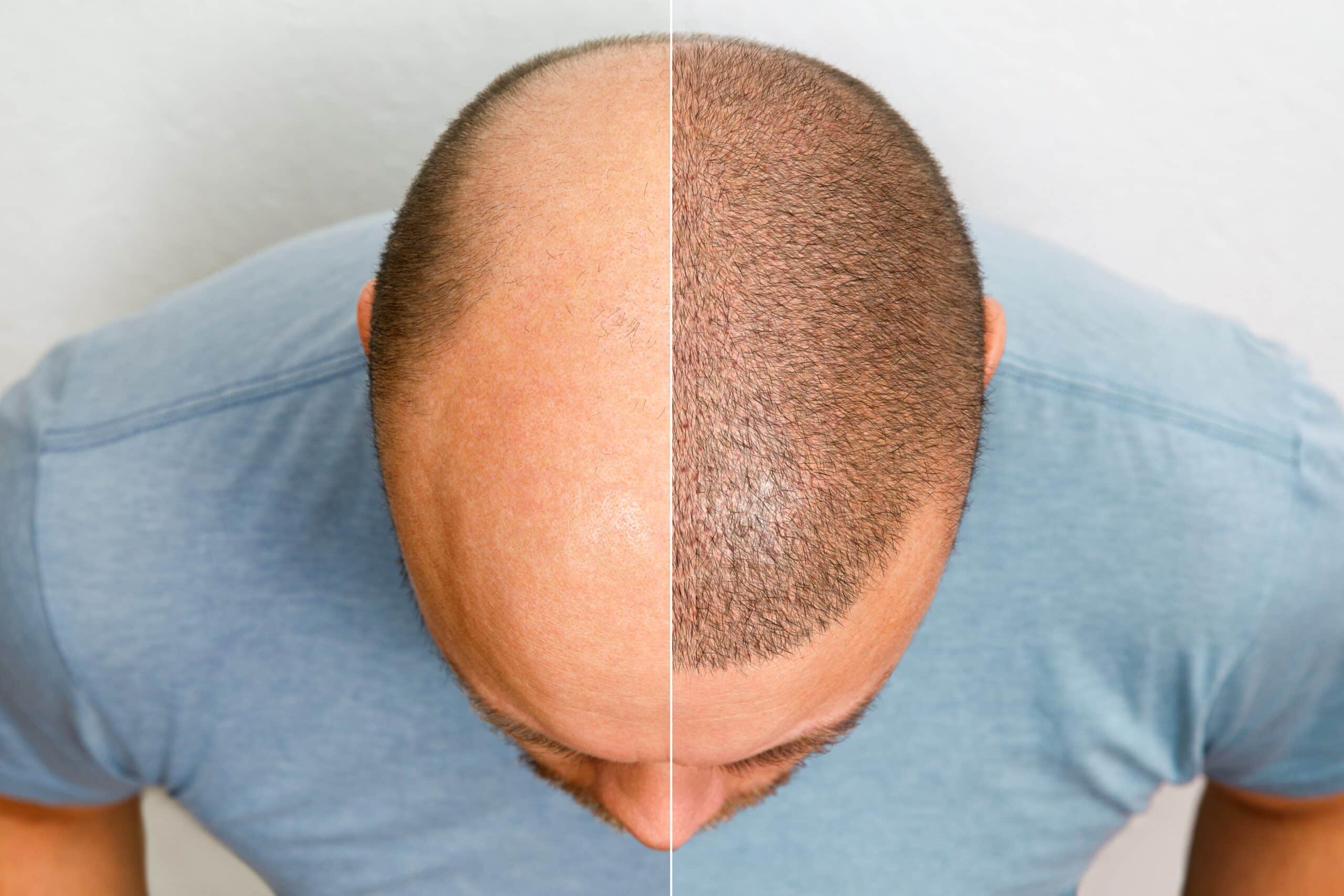 Hair Transplant UK – Expert FUE and FUT Procedures Explained
